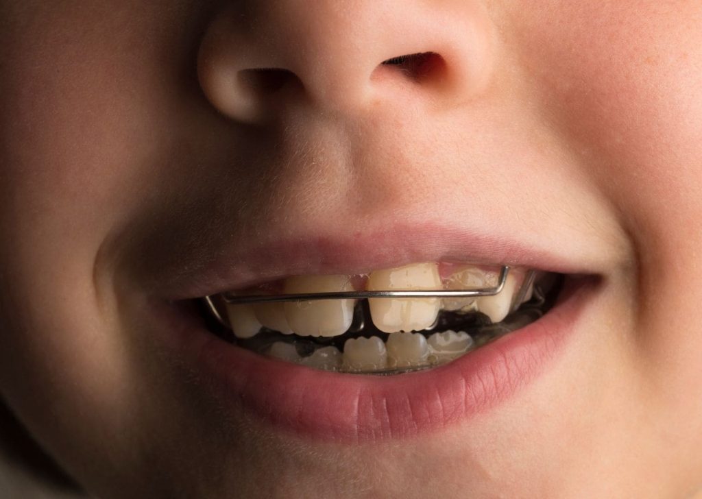 Orthodontie Enfants à Villeneuve d’Ascq (3)