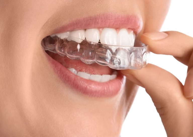 Aligneur transparent tenu entre deux doigts, traitement d'orthodontie invisible, cabinet des Drs Yvart à Villeneuve d'Ascq