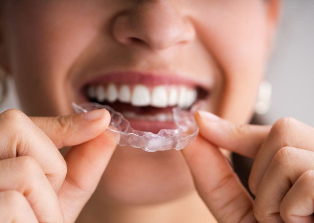 Orthodontie Invisible à Villeneuve d’Ascq