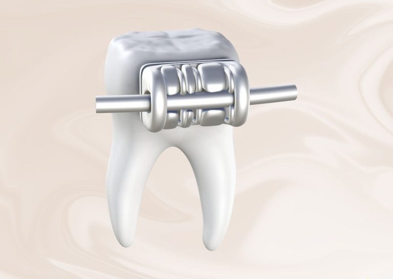 Attache d'orthodontie linguale collée à l'intérieur de la dent, technique invisible pour adultes