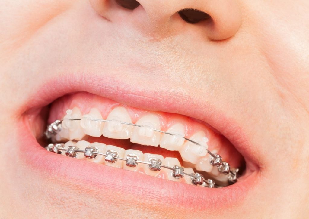 Orthodontie adolescents à Villeneuve d’Ascq