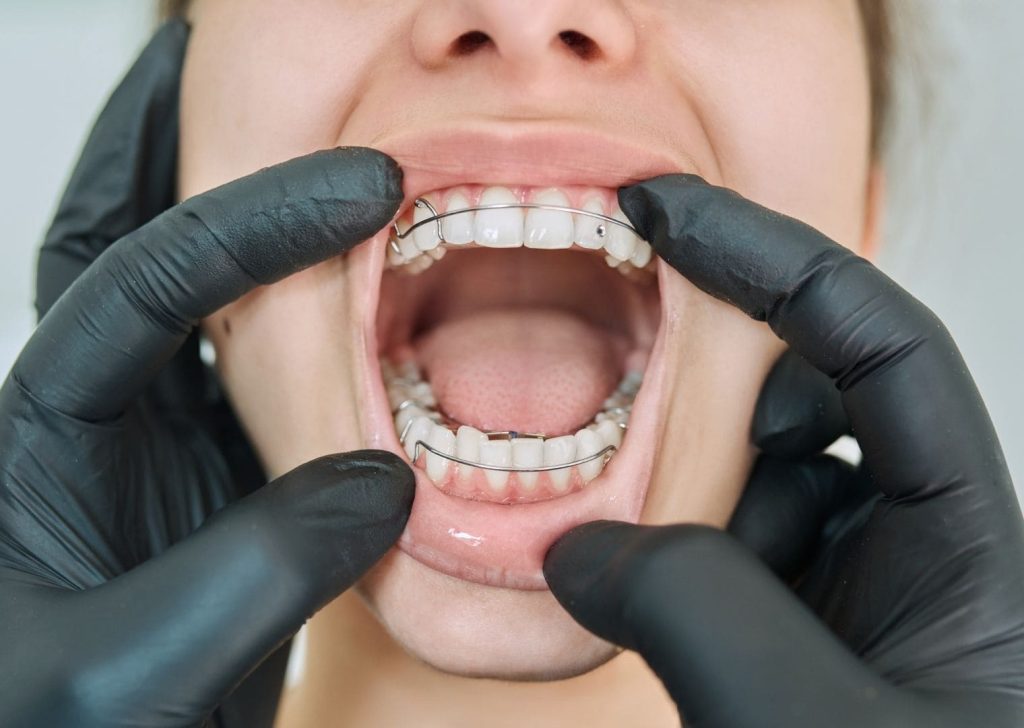 Orthodontie adolescents à Villeneuve d’Ascq (7)