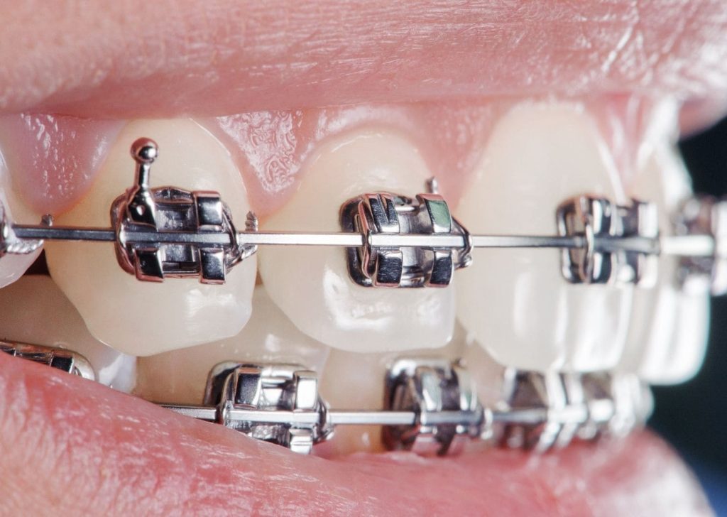 Orthodontie adultes à Villeneuve d’Ascq