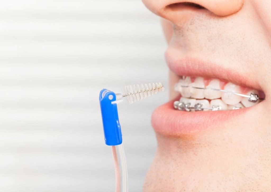 Orthodontie adultes à Villeneuve d’Ascq (12)