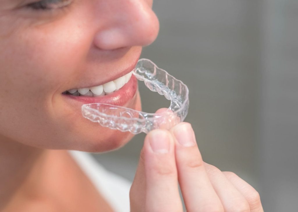 Orthodontie adultes à Villeneuve d’Ascq (5)