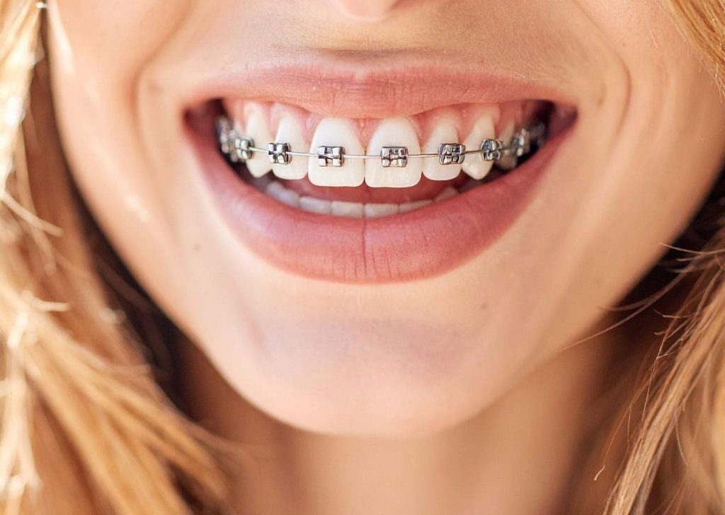 Orthodontie adultes à Villeneuve d’Ascq (8)